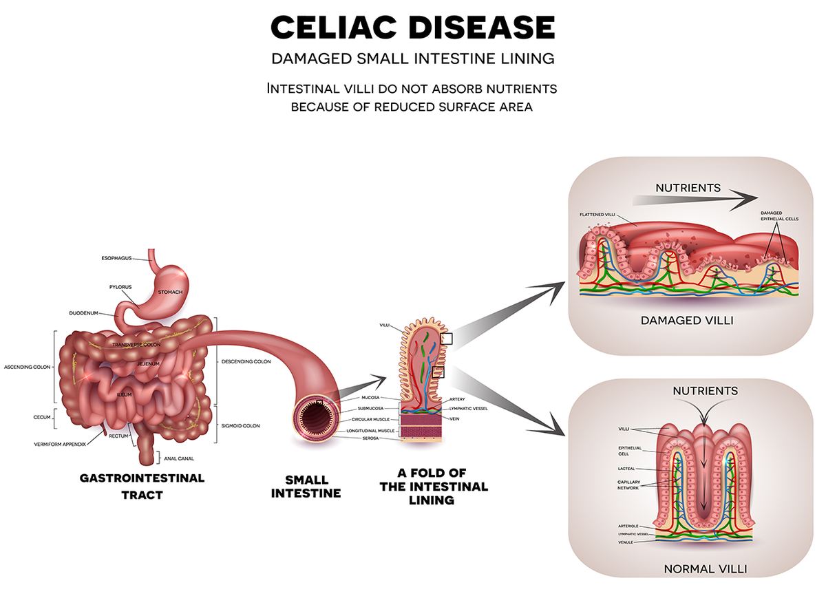 What is Coeliac disease? – ACOVIOR